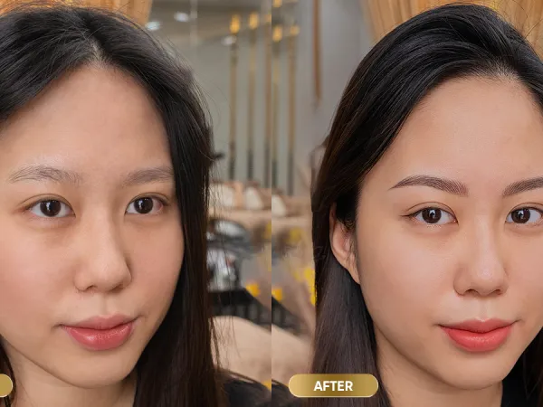 Không đo tỉ lệ khuôn mặt trước khi làm
