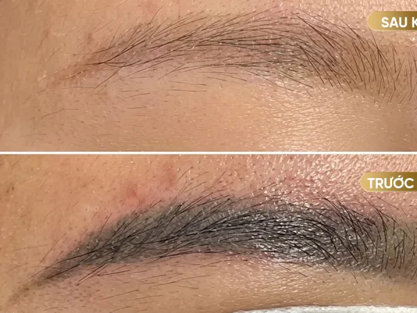 Xử lý đúng cách thì không để lại sẹo
